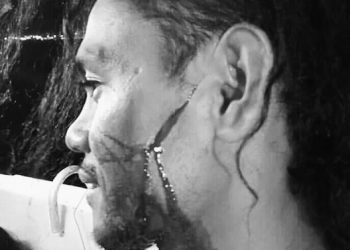 Wajah Petrus Crisologus Tunabenani diduga terkena benda tajam. Petrus adalah salah satu dari 7 ABK yang hilang di perairan Mauritius