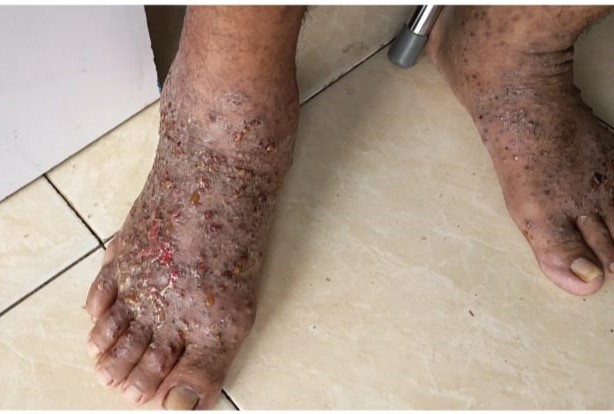 Kedua kaki Marselinus Seke, PMI NTT yang dideportase dari Malaysia penuh luka. (Rita Hasugian - KatongNTT) 